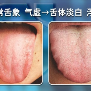 聚健康20150817：《望舌辨体质-2》气虚的类型及舌苔表现