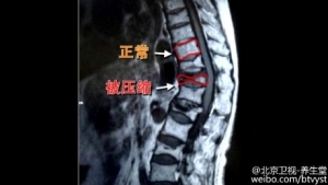 《养生堂》20150917视频笔记:《“隐形”骨折危害大》压缩性骨折