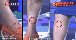 我是大医生20151001视频和笔记:张嘉讲肺栓塞 血栓 闭塞性动脉硬化 骨科熏洗药
