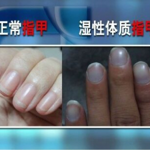 聚健康20151006:漆浩讲《节日聚健康》第五集 出现湿症的表现该怎么办？