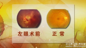 《养生堂》20151010:《血管隐患“看”出来》飞蚊症 眼底出血 视网膜静脉阻塞