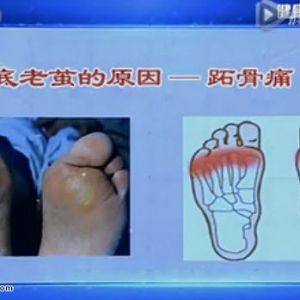 《健康之路》20151027:孙超讲脚痛之苦(上 )脚后跟痛的原因 前脚掌痛的原因 脚背痛的原因
