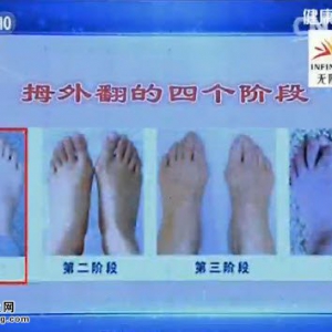 《健康之路》20151028:孙超讲脚痛之苦(下 )鞋子与脚型的关系 脚趾变形对生活的影响