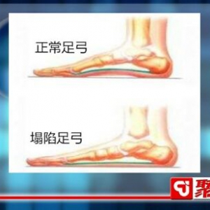 聚健康20151030:韩洪《你知足吗-4》活血止痛泡脚方 如何避免足弓塌陷