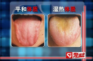 聚健康20151202:于振宣讲《望舌辨体质-4》三仁汤 湿热体质的表现及调理