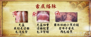 《养生堂》20160113笔记:《古方新用巧降糖—补虚》糖尿病并发症