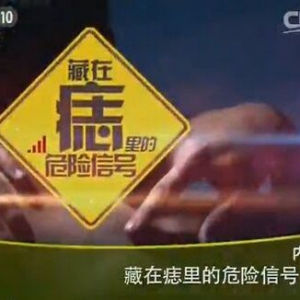 《健康之路》20160129笔记:痣和黑色素瘤的区别、哪种外形的痣会癌变？