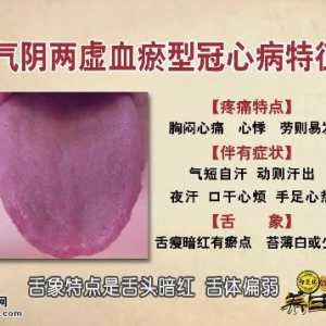饮食养生汇20160131视频和笔记:气阴两虚血瘀型冠心病的特点及缓解方法
