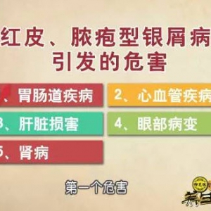 饮食养生汇20160206视频和笔记:脓疱型牛皮癣特点、牛皮癣导致的疾病