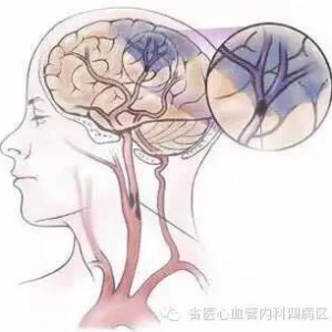 脑血栓发病前的10个症状表现