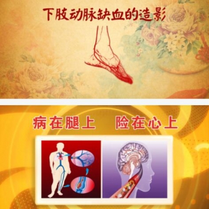《养生堂》20160305视频和笔记:《通畅生命要道—2》下肢缺血、下肢动脉栓塞