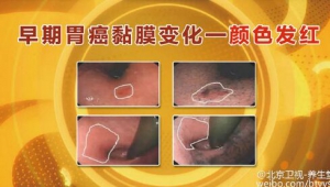 《养生堂》20160316视频:胃癌的四大症状、什么样的人需要胃癌筛查？
