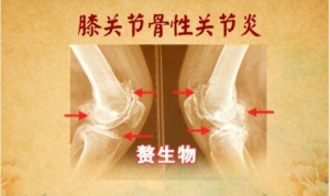 《养生堂》20160327视频笔记:《膝活筋柔人不老》膝关节骨性关节炎的典型症状及自测方法