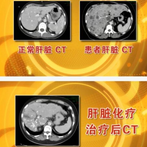 《养生堂》20160402视频笔记:癌症的综合治疗误区、癌症化疗副作用大吗？疗效有限吗？