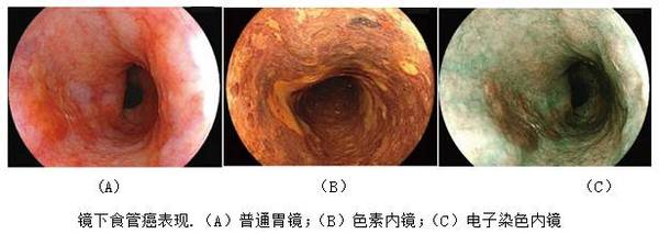 早期食管癌诊断与治疗?