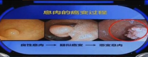 《健康之路》20160415视频和笔记:刘骞《能治好的癌症（一）》肠癌的症状和检查治疗