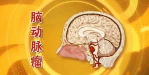 《养生堂》20160425视频和笔记:张鸿祺、脑动脉瘤、脑出血、出血性卒中、缺血性卒中