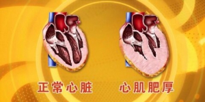 北京卫视20160513《养生堂》视频笔记:心肌肥厚、心肌肥大、心衰、地中海饮食、夏季降压
