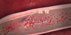 北京卫视20160524《养生堂》甄文俊、刘兵、冠状动脉痉挛、冠心病、心肌梗塞、心脏搭桥