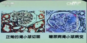 《健康之路》20160704视频和笔记: 周福德、糖尿病肾损害、优质蛋白、蛋白尿