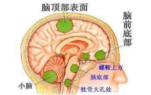 常见颅内肿瘤鉴别诊断要点