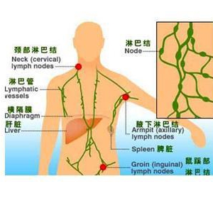 淋巴瘤的早期表现与调理预防