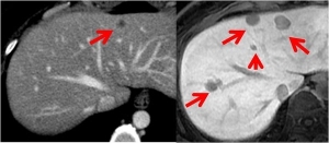 肝脏肿瘤筛查，到底选择B超？CT?还是MRI?