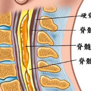 髓空洞症患者肌肉萎缩后可能导致哪些并发症?