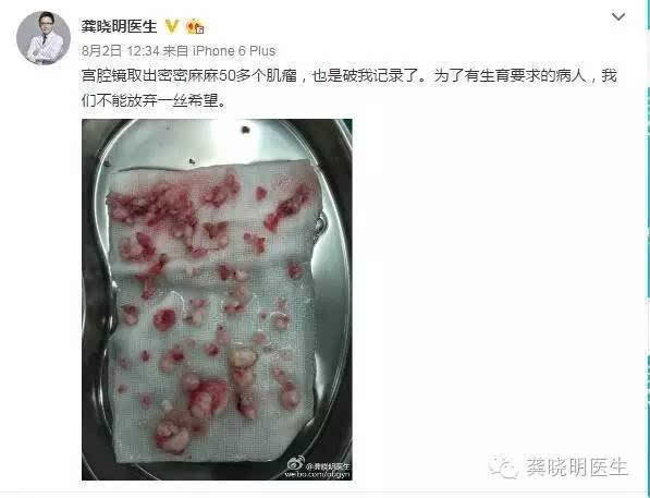 宫腔镜冷刀切除子宫肌瘤有什么优势?