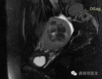 宫腔镜冷刀切除子宫肌瘤有什么优势?