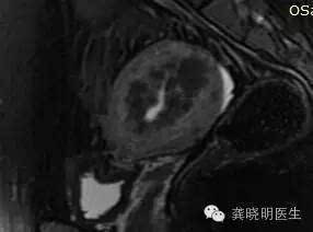 宫腔镜冷刀切除子宫肌瘤有什么优势?