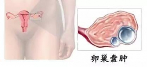 卵巢如何保养？卵巢囊肿和卵巢癌到底有没有关系？