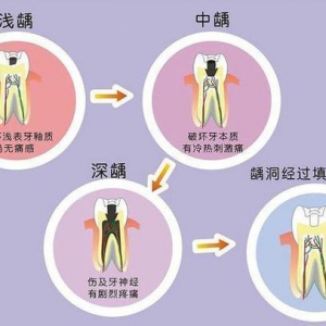 常见口腔疾病：龋齿的危害、龋齿的发病原因及防治