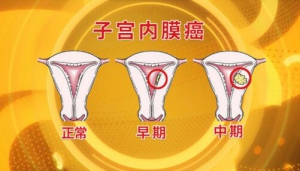 北京卫视20160826《养生堂》雌激素、子宫内膜癌、肥胖、高血压、高血糖 、大豆异黄酮