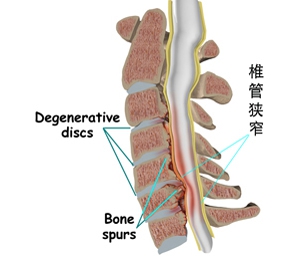 间歇性跛行与椎管狭窄
