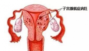 “不死的癌症”—女性子宫腺肌症