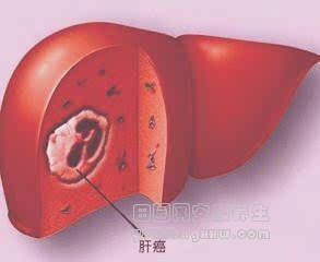 肝癌早期的蛛丝马迹