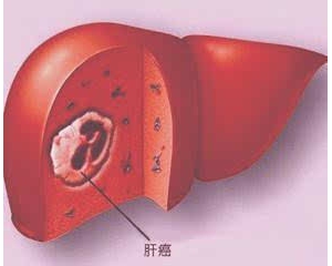 肝癌早期的蛛丝马迹