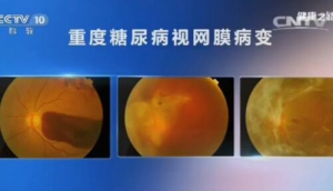 《健康之路》20161016：失明与糖尿病、糖尿病视网膜病变、高血压视网膜病变、黄斑病变