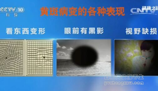 《健康之路》20161016:失明与糖尿病、糖尿病视网膜病变、高血压视网膜病变、黄斑病变