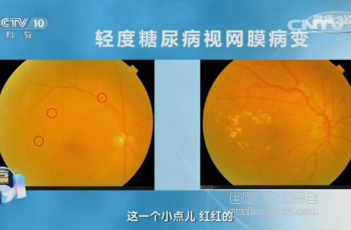 《健康之路》20161016:失明与糖尿病、糖尿病视网膜病变、高血压视网膜病变、黄斑病变