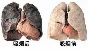 《科普》：为什么提倡肺癌早期筛查？
