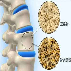 常喝碳酸饮料危害可不只是导致肥胖