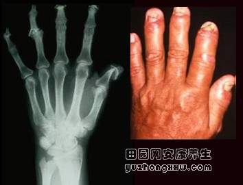 银屑病性关节炎如何诊治