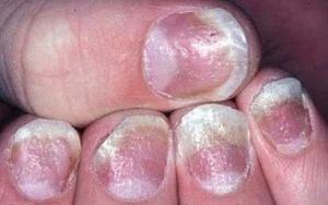 银屑病性关节炎如何诊治