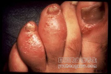 40岁的脊髓灰质炎后遗症能治么_脊髓型灰质炎后遗症的功能障碍_脊髓灰质炎后遗症能治好吗