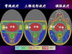 头颈部肿瘤放疗的全身反应及注意事项