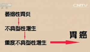 《健康之路》20161119毕晓峰《癌症测出来（上）》胃癌筛查、肺癌筛查