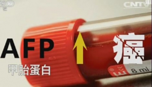 《健康之路》20161120毕晓峰《癌症测出来（下）》肝癌、结肠癌、乳腺癌、宫颈癌、肠癌
