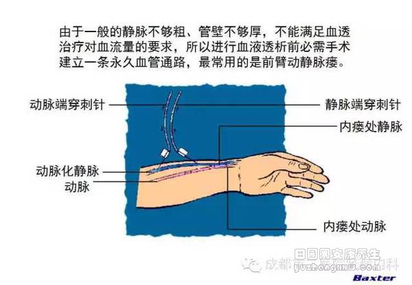 科普：血液透析和腹膜透析